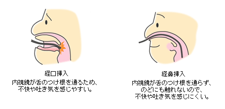 経口挿入と経鼻挿入