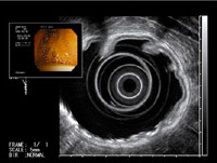 超音波内視鏡画像　スコープ全景・超音波内視鏡　先端