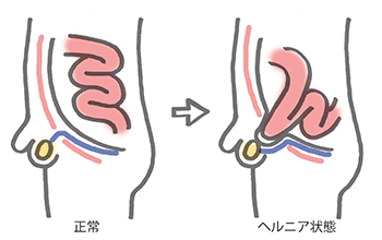 腸管の正常な位置とヘルニア状態