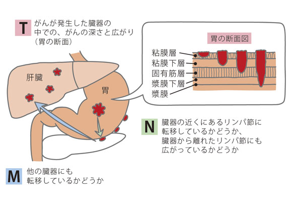 TNM分類でステージを決める際の基準