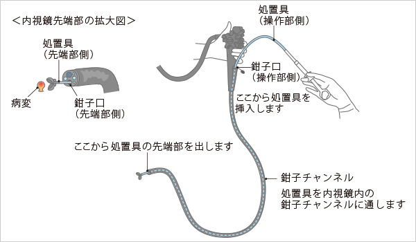 処置具」って、どんなもの？｜オリンパス おなかの健康ドットコム