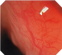 食道の通常光観察画像