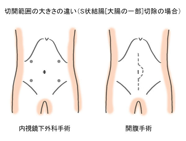 切開範囲の大きさの違い（S状結腸[大腸の一部]切除の場合）