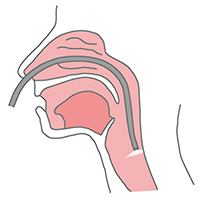経鼻挿入法