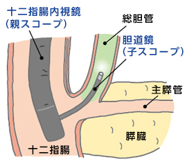 親子方式経口胆道鏡