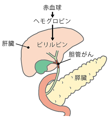 胆管 癌 余命