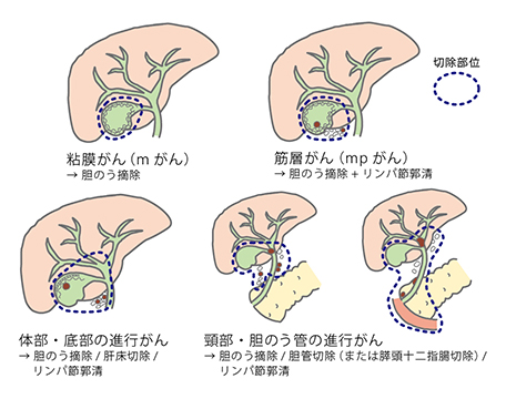 胆道がん（胆管がん・胆のうがん）の治療と予防