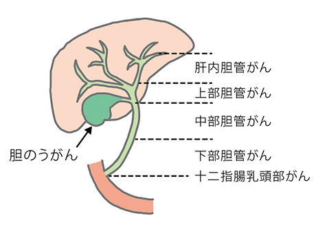 胆管がんはどのように治療されますか?