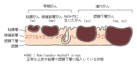 原因 ん 胆嚢 が