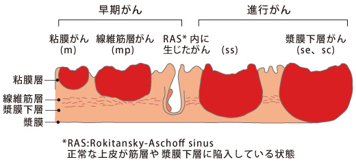 早期胆道がんと進行性胆道がん