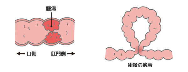 原因 腸閉塞