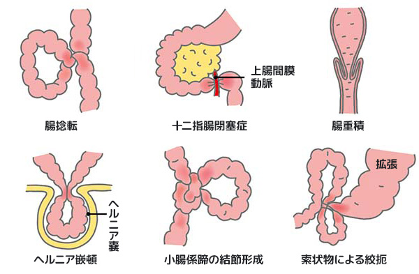 腸閉塞 イレウス オリンパス おなかの健康ドットコム