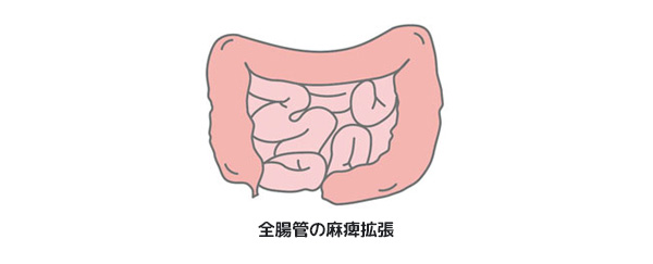 腸閉塞 イレウス オリンパス おなかの健康ドットコム