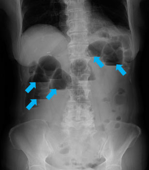 腹部のX線写真