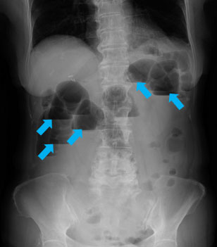 腸閉塞 イレウス オリンパス おなかの健康ドットコム