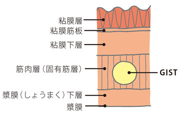 消化管間質腫瘍 Gist オリンパス おなかの健康ドットコム