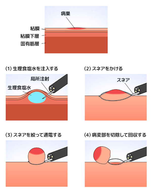 ループを目的の組織に掛けます。しばり通電して、切除します。