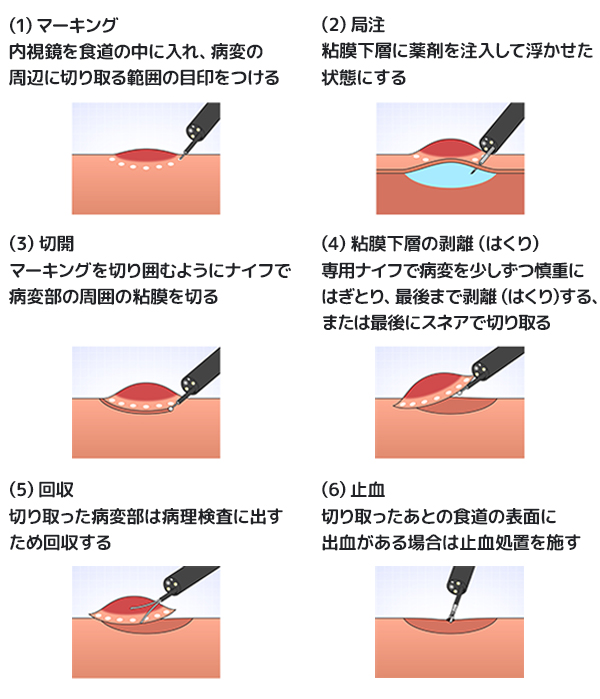 ループを目的の組織に掛けます。しばり通電して、切除します。
