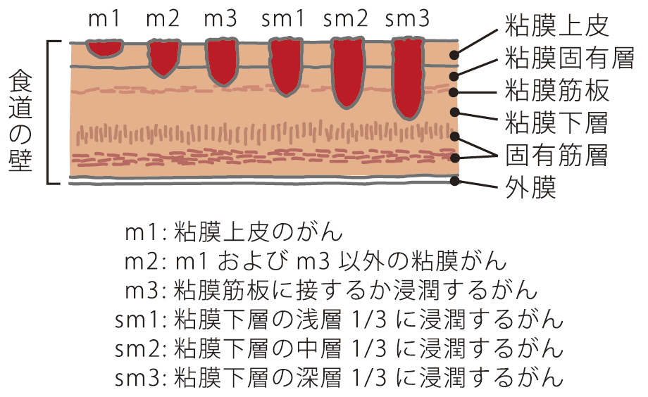 食道表在がんの深達度分類