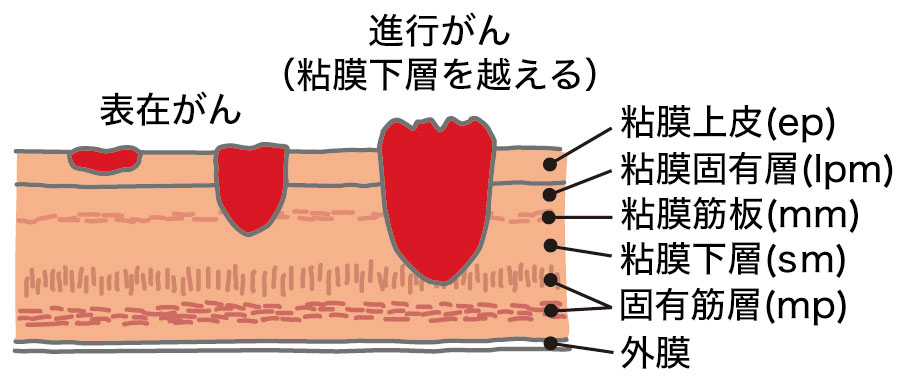 表在がんと進行がんの肉眼的分類