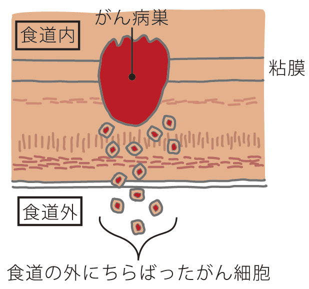 食道外への転移の仕組み