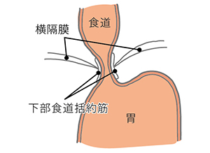 食道 バレット