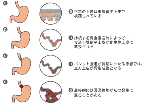 バレット食道 オリンパス おなかの健康ドットコム