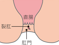 裂肛