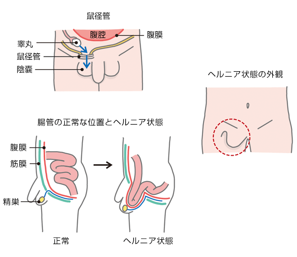 ヘルニア 鼠蹊