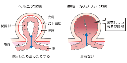 ヘルニア 鼠蹊