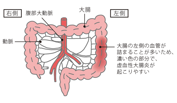 虚血性大腸炎の好発部位