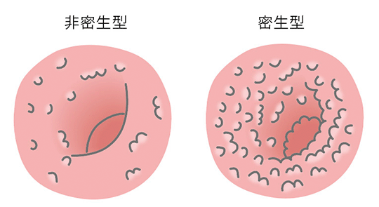 大腸ポリポーシス（消化管ポリポーシス）