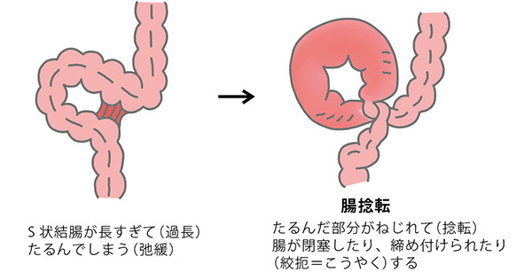 S状結腸軸捻転症が形成される過程