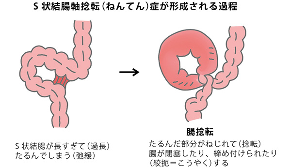 S状結腸軸捻転症 オリンパス おなかの健康ドットコム