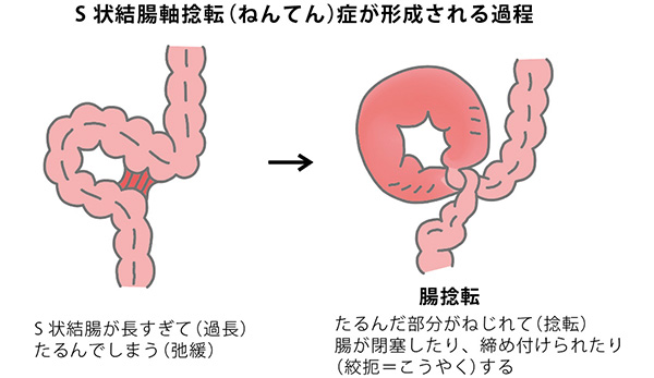S状結腸軸捻転症が形成される過程