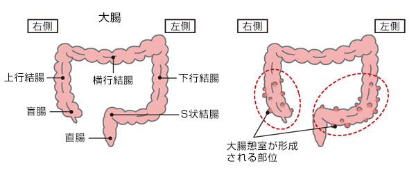 大腸憩室の形成部位
