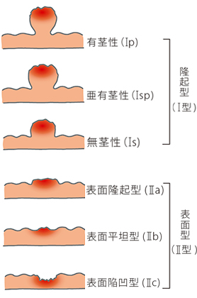 大腸早期がんの肉眼的分類