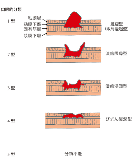 大腸がんの肉眼的分類