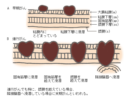 症状 大腸 癌