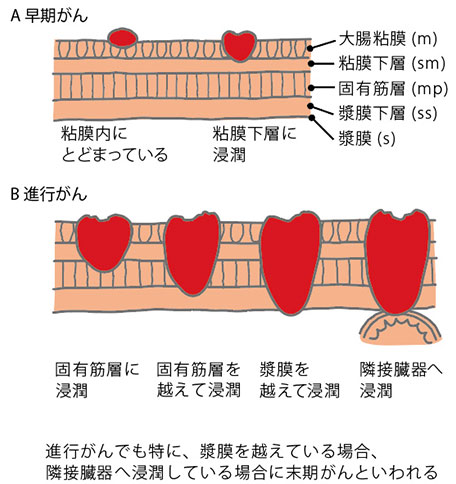 がんの浸潤度による早期・進行がんの分類