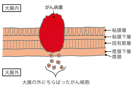 腹膜転移の仕組み