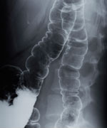大腸のX線画像