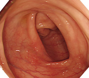 大腸の内視鏡写真