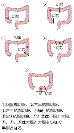 結腸がんの手術