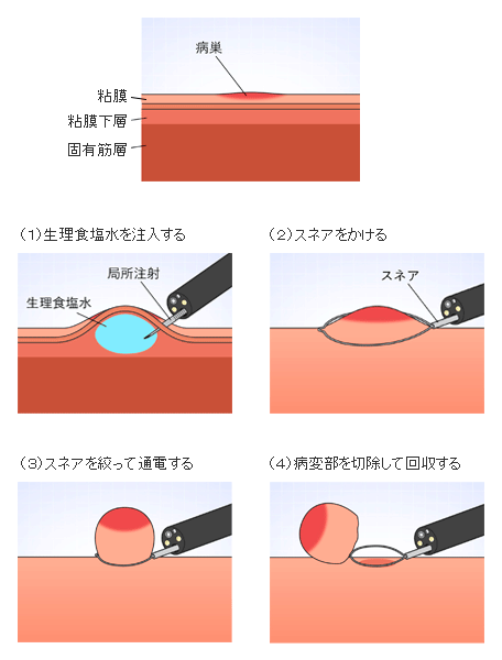 EMRの手技