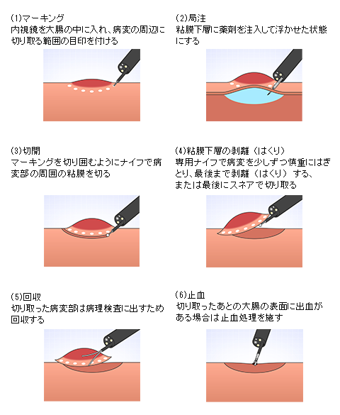 ESDの手技