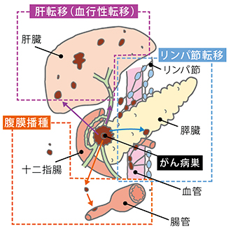 膵臓 癌 の 原因