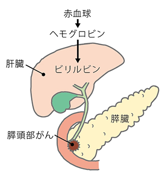 閉塞性黄疸