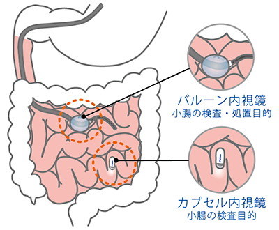 バルーン内視鏡・カプセル内視鏡