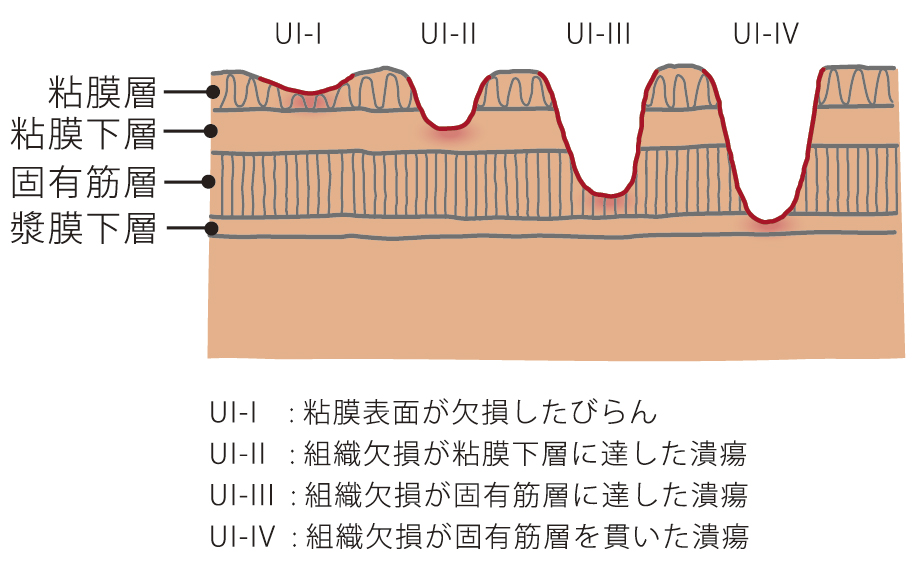 びらんと潰瘍のちがい